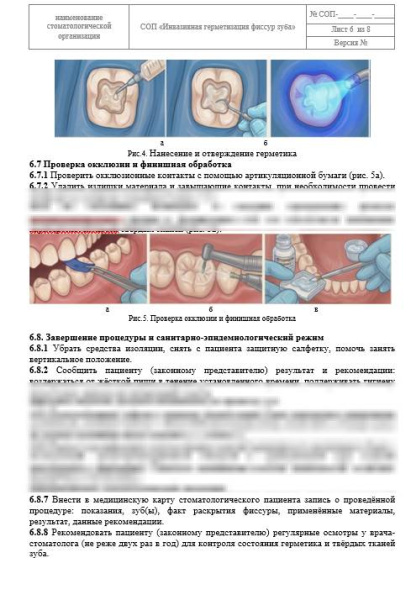 СОП «Инвазивная герметизация фиссур зуба»